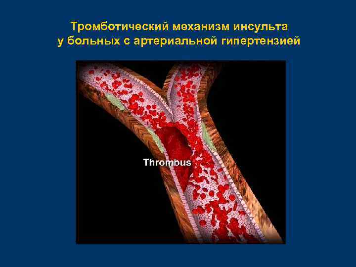 Тромботический механизм инсульта у больных с артериальной гипертензией 