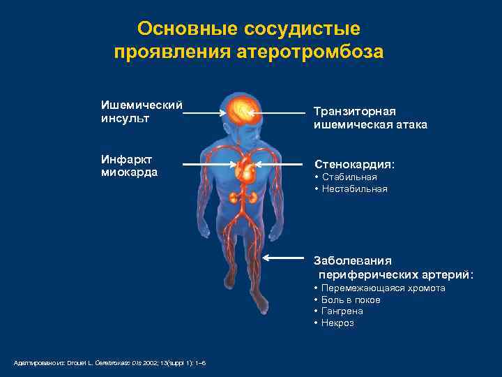 Основные сосудистые проявления атеротромбоза Ишемический инсульт Инфаркт миокарда Транзиторная ишемическая атака Стенокардия: • Стабильная