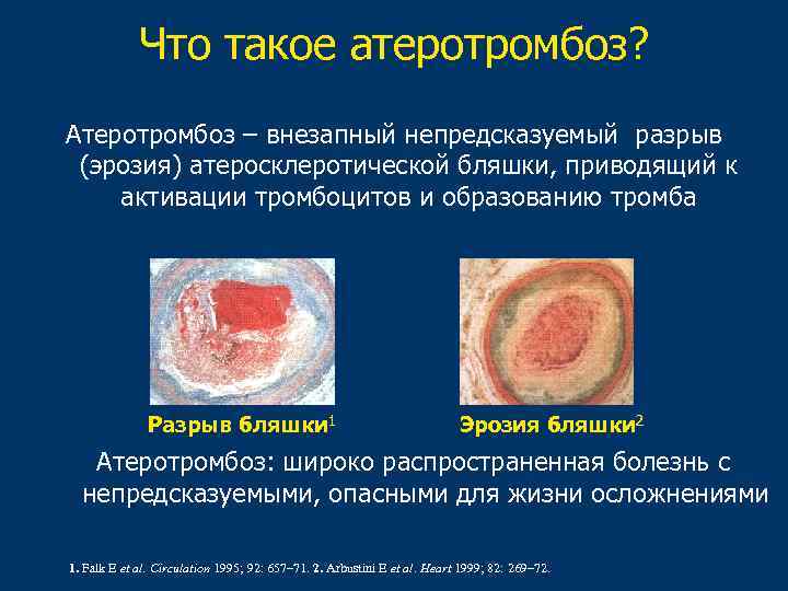 Что такое атеротромбоз? Aтеротромбоз – внезапный непредсказуемый разрыв (эрозия) атеросклеротической бляшки, приводящий к активации