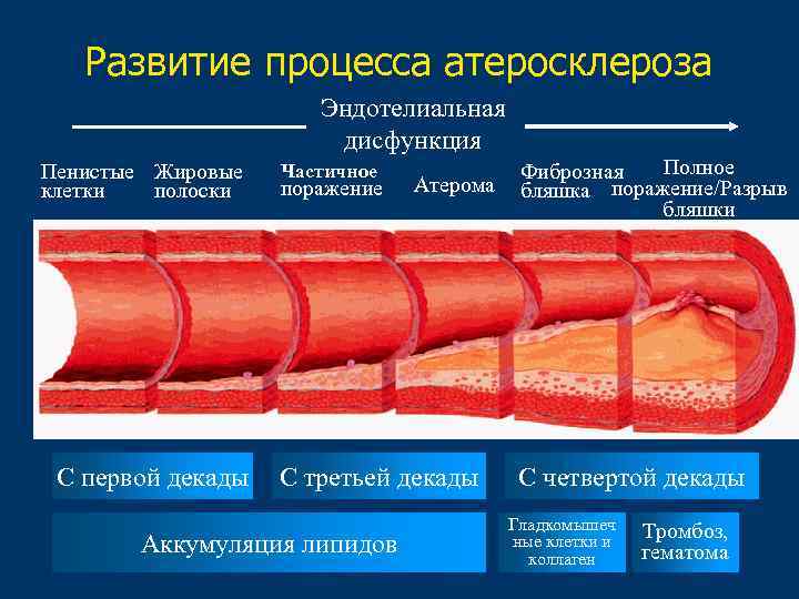 Развитие процесса атеросклероза Эндотелиальная дисфункция Пенистые Жировые клетки полоски С первой декады Частичное поражение