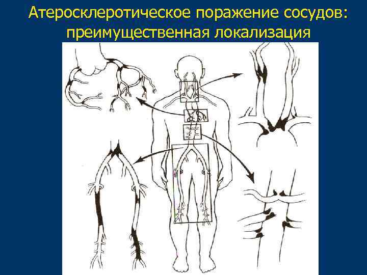 Атеросклеротическое поражение сосудов: преимущественная локализация 