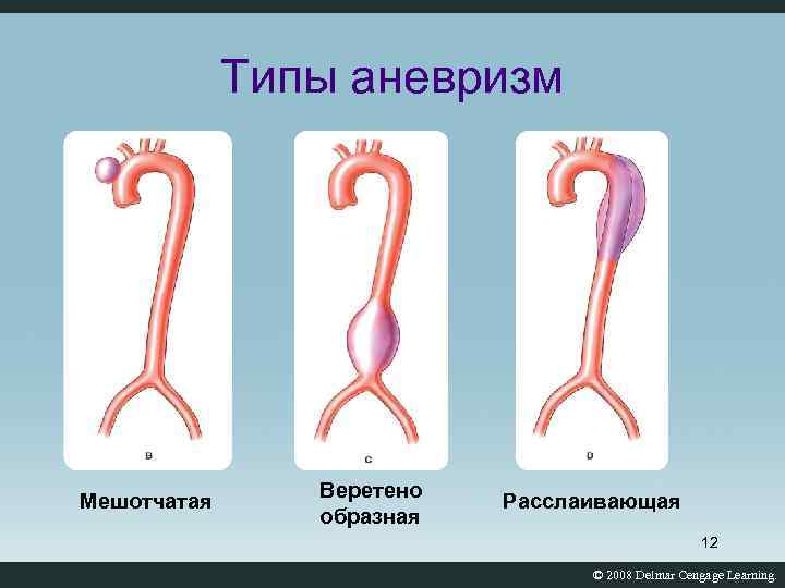 Мешотчатые аневризмы вса. Мешотчатая аневризма сосудов. Мешотчатая аневризма аорты. Строение мешотчатой аневризмы.