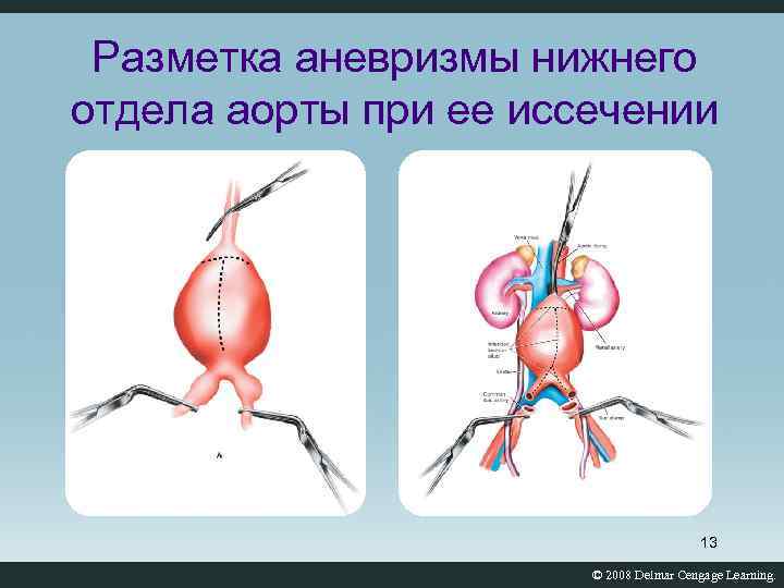 Разметка аневризмы нижнего отдела аорты при ее иссечении 13 © 2008 Delmar Cengage Learning.