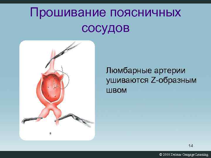 Прошивание поясничных сосудов Люмбарные артерии ушиваются Z-образным швом 14 © 2008 Delmar Cengage Learning.