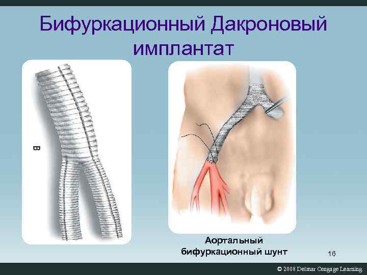 Бифуркационный Дакроновый имплантат Аортальный бифуркационный шунт 16 © 2008 Delmar Cengage Learning. 