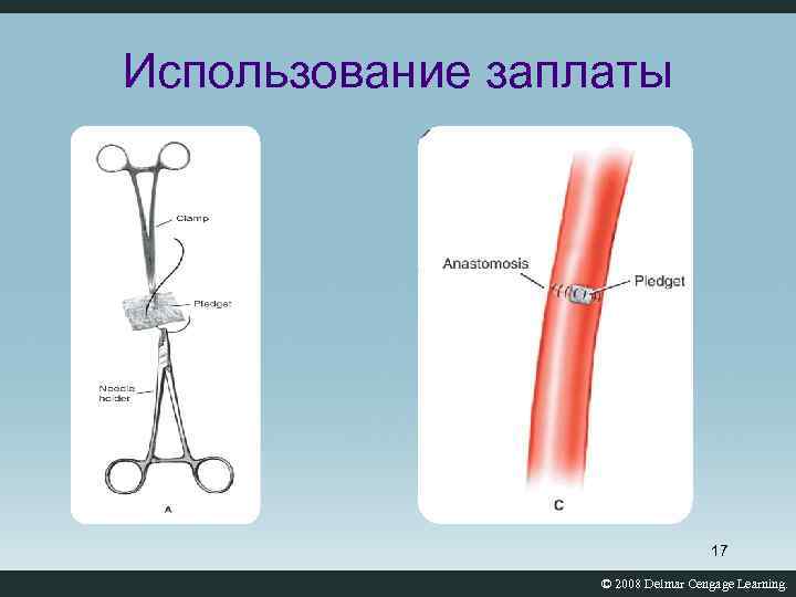 Использование заплаты 17 © 2008 Delmar Cengage Learning. 