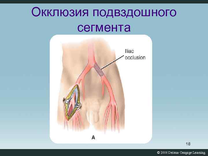 Окклюзия подвздошного сегмента 18 © 2008 Delmar Cengage Learning. 