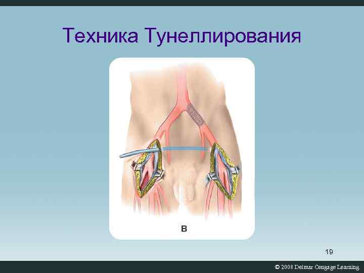 Техника Тунеллирования 19 © 2008 Delmar Cengage Learning. 