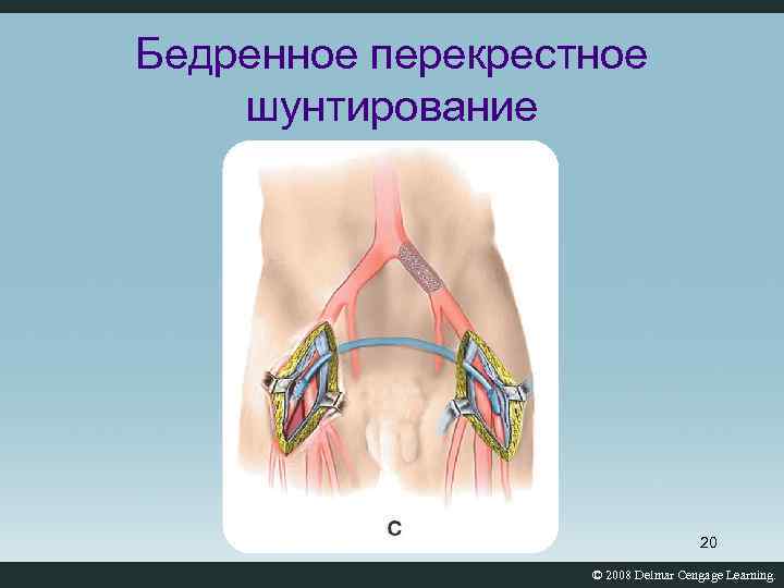 Бедренное перекрестное шунтирование 20 © 2008 Delmar Cengage Learning. 