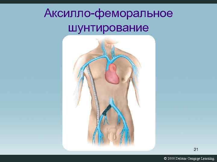 Аксилло-феморальное шунтирование 21 © 2008 Delmar Cengage Learning. 