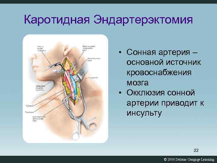 После каротидной эндартерэктомии. Эндартерэктомия сонной артерии. Каротидная эндартерэктоми. Операция каротидная эндартерэктомия.