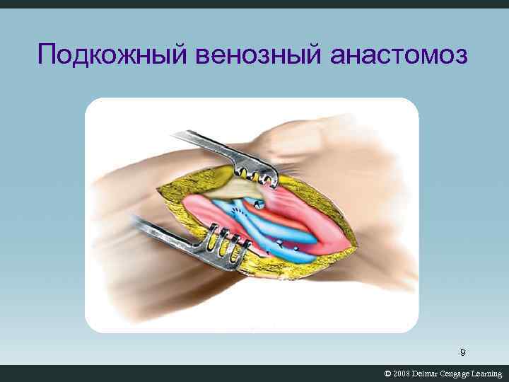 Подкожный венозный анастомоз 9 © 2008 Delmar Cengage Learning. 