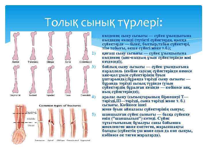 Толық сынық түрлері: 1) 2) 3) 4) 5) келденең сыну сызығы — сүйек ұзындығына