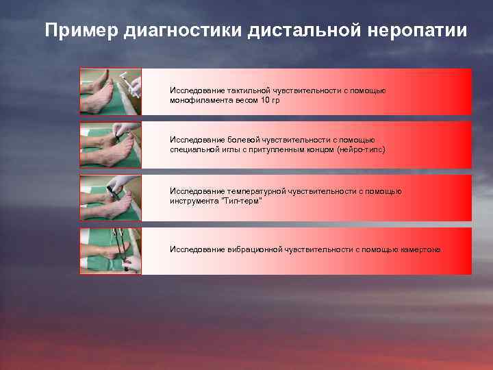 Пример диагностики дистальной неропатии Исследование тактильной чувствительности с помощью монофиламента весом 10 гр Исследование