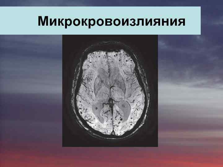  Mикрокровоизлияния 