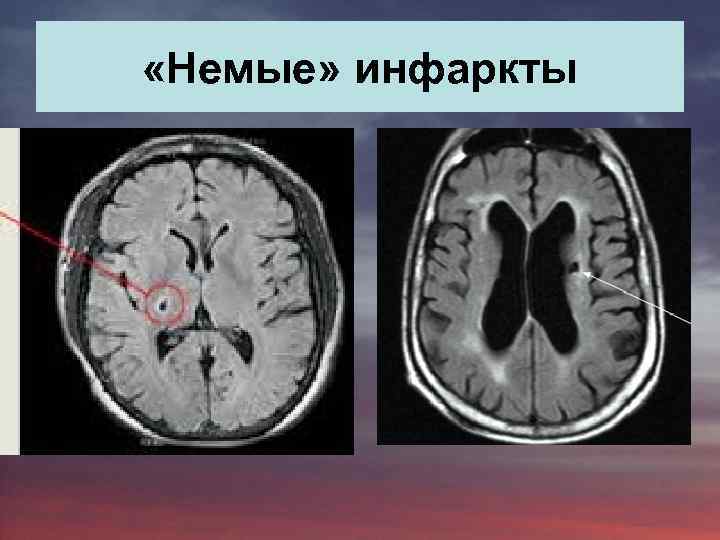  «Немые» инфаркты 