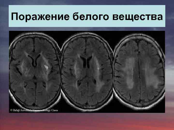 Поражение белого вещества 