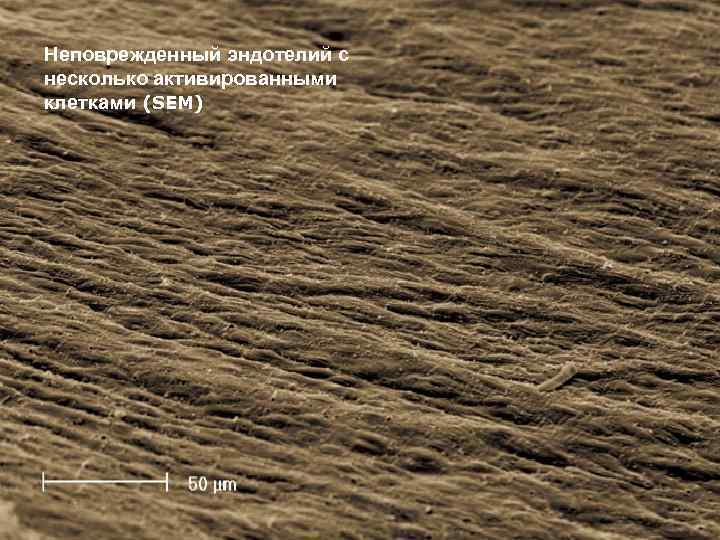 Неповрежденный эндотелий с несколько активированными клетками (SEM) 