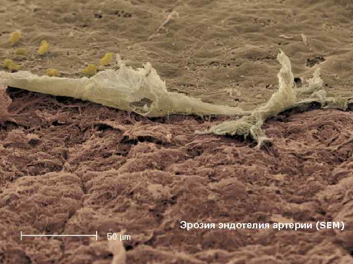 Эрозия эндотелия артерии (SEM) 
