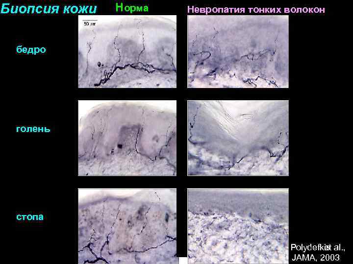 Биопсия кожи Норма Невропатия тонких волокон бедро голень стопа Polydefkis al. , et JAMA,