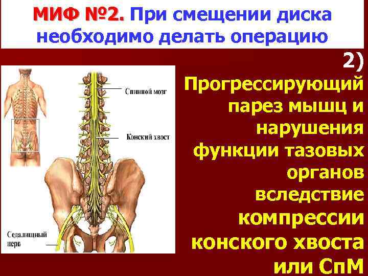 МИФ № 2. При смещении диска необходимо делать операцию 2) Прогрессирующий парез мышц и