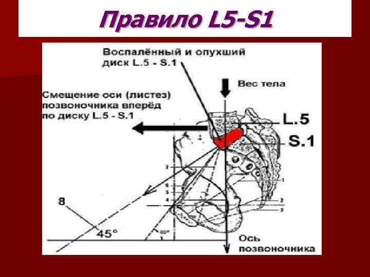 Правило L 5 -S 1 