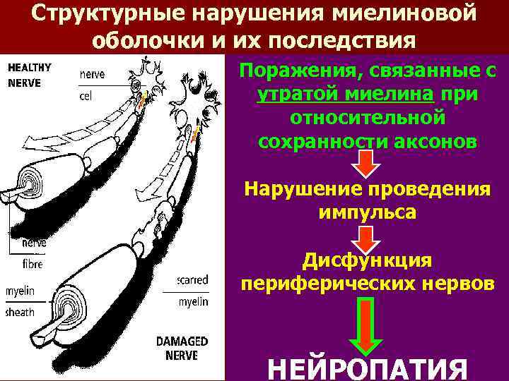 Структурные нарушения миелиновой оболочки и их последствия Поражения, связанные с утратой миелина при относительной