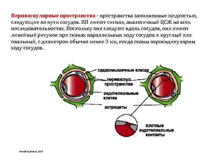 Периваскулярные пространства - пространства заполненные жидкостью, следующие по пути сосудов. ПП имеют сигнал, аналогичный