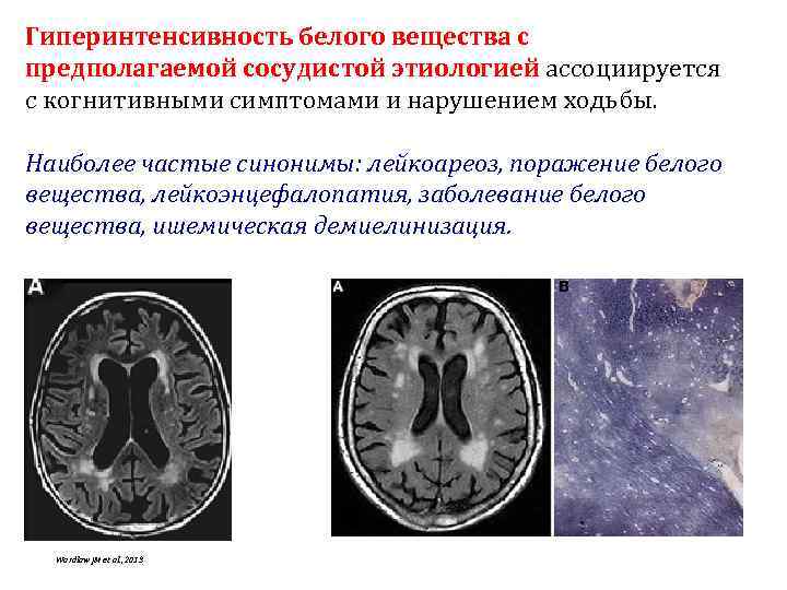 Гиперинтенсивность белого вещества с предполагаемой сосудистой этиологией ассоциируется с когнитивными симптомами и нарушением ходьбы.