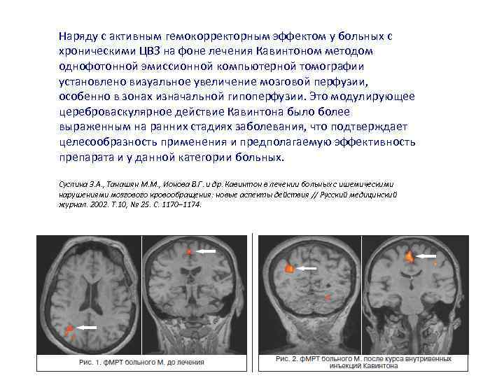 Наряду с активным гемокорректорным эффектом у больных с хроническими ЦВЗ на фоне лечения Кавинтоном