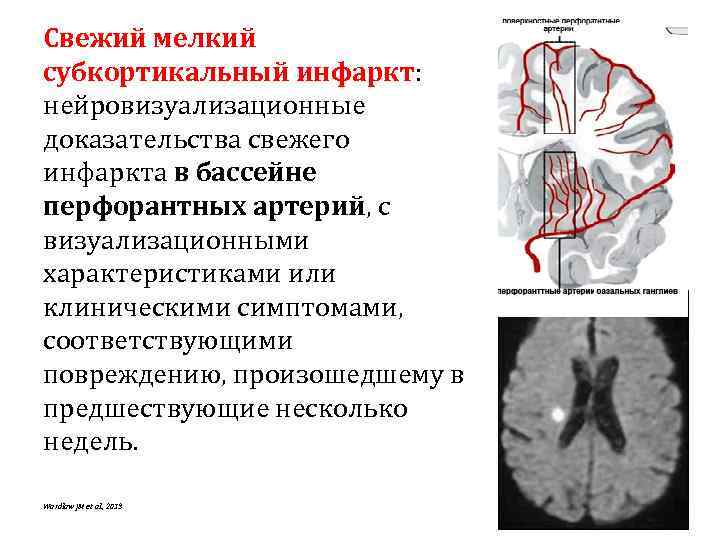 Свежий мелкий субкортикальный инфаркт: нейровизуализационные доказательства свежего инфаркта в бассейне перфорантных артерий, с визуализационными