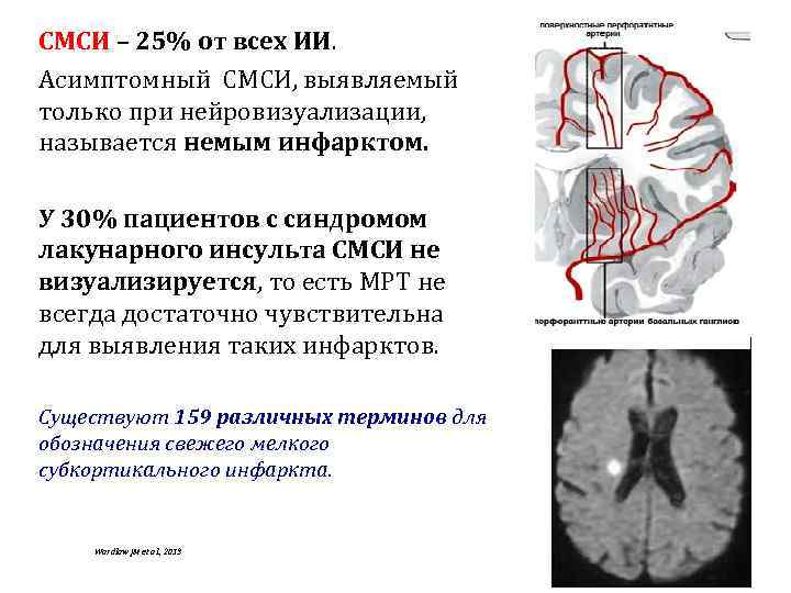СМСИ – 25% от всех ИИ. Асимптомный СМСИ, выявляемый только при нейровизуализации, называется немым