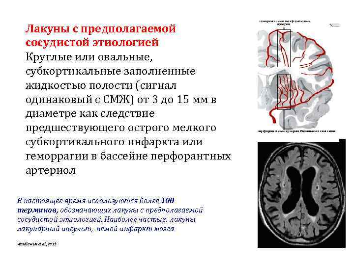 Лакуны с предполагаемой сосудистой этиологией Круглые или овальные, субкортикальные заполненные жидкостью полости (сигнал одинаковый
