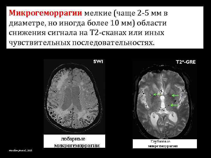 Микрогеморрагии мелкие (чаще 2 -5 мм в диаметре, но иногда более 10 мм) области