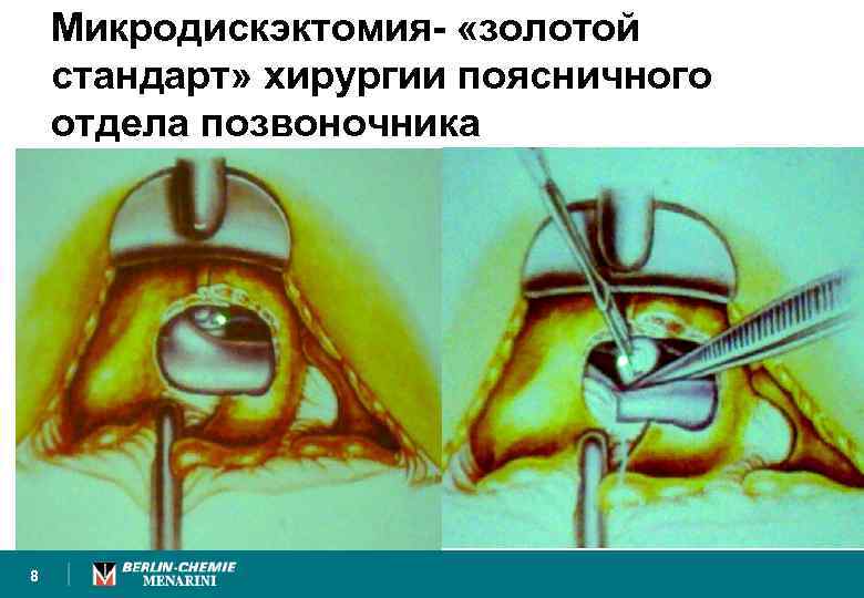 Микродискэктомия- «золотой стандарт» хирургии поясничного отдела позвоночника 8 