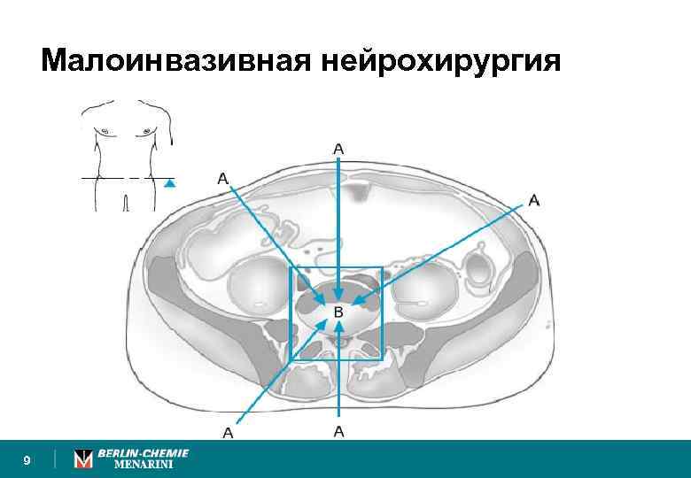 Малоинвазивная нейрохирургия 9 