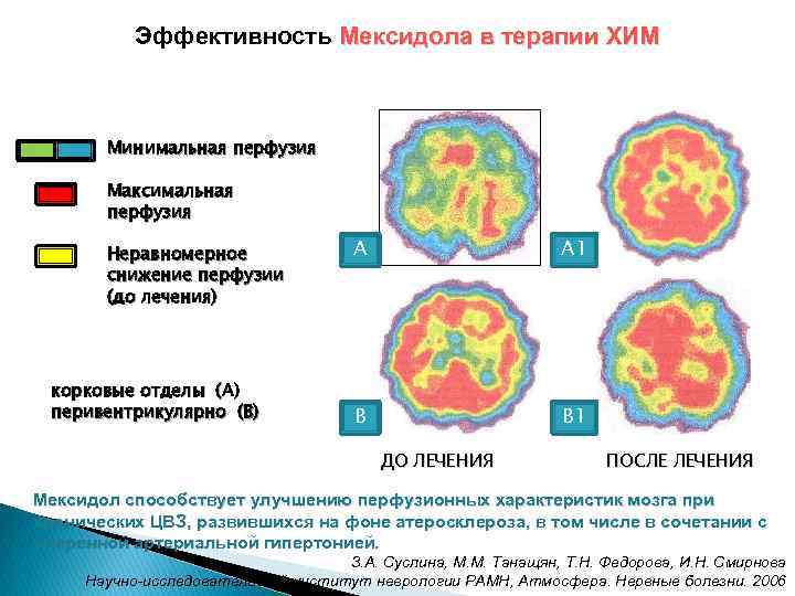 Эффективность Мексидола в терапии ХИМ Минимальная перфузия Максимальная перфузия Неравномерное снижение перфузии (до лечения)