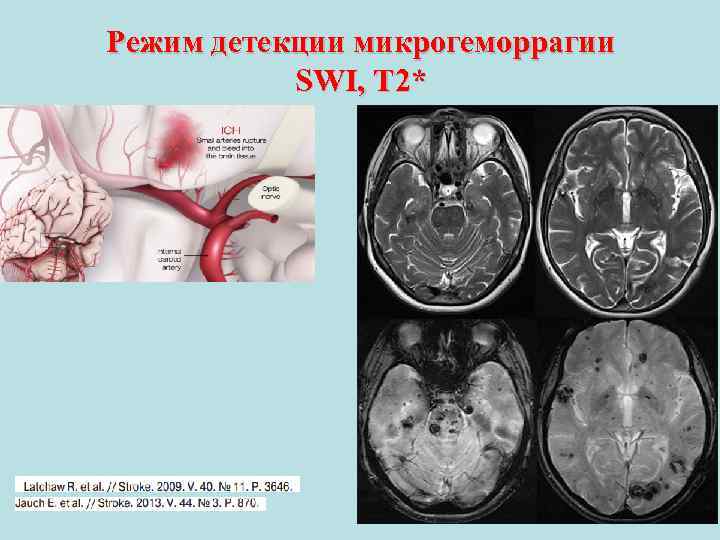 Режим детекции микрогеморрагии SWI, T 2* 