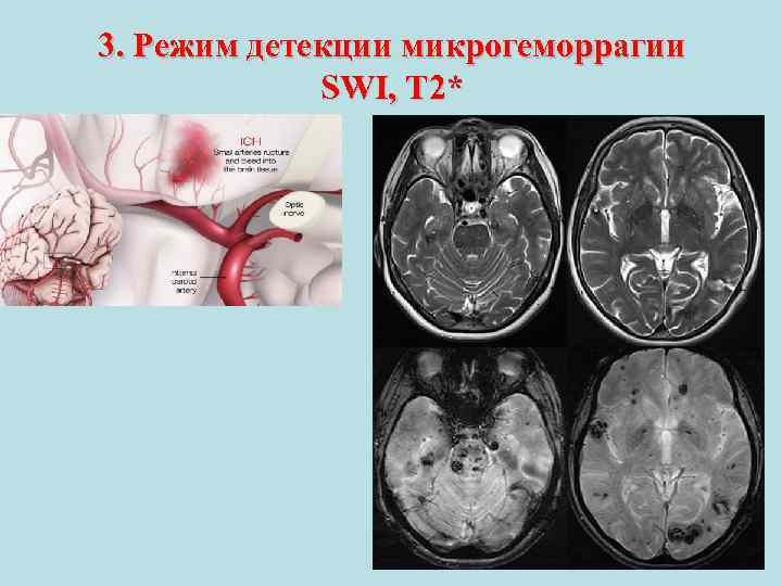 3. Режим детекции микрогеморрагии SWI, T 2* 