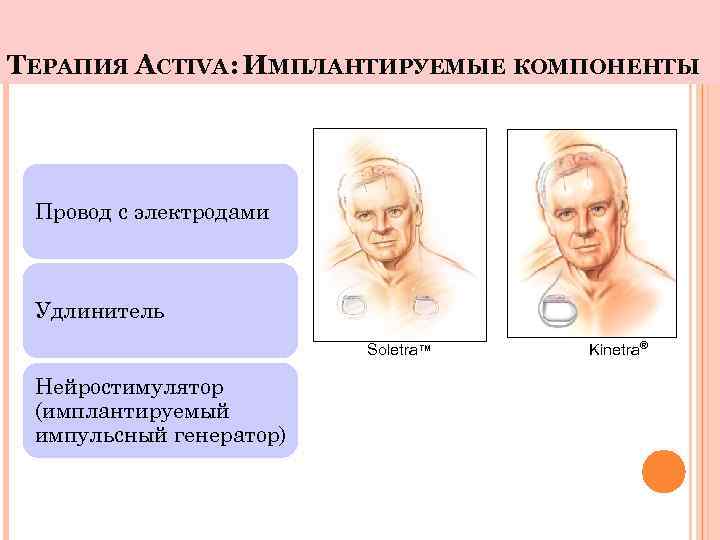 ТЕРАПИЯ ACTIVA: ИМПЛАНТИРУЕМЫЕ КОМПОНЕНТЫ Провод с электродами Удлинитель Soletra™ Нейростимулятор (имплантируемый импульсный генератор) Kinetra®