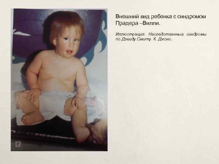 Внешний вид ребенка с синдромом Прадера –Вилли. Иллюстрация. Наследственные синдромы по Дэвиду Смиту. К.