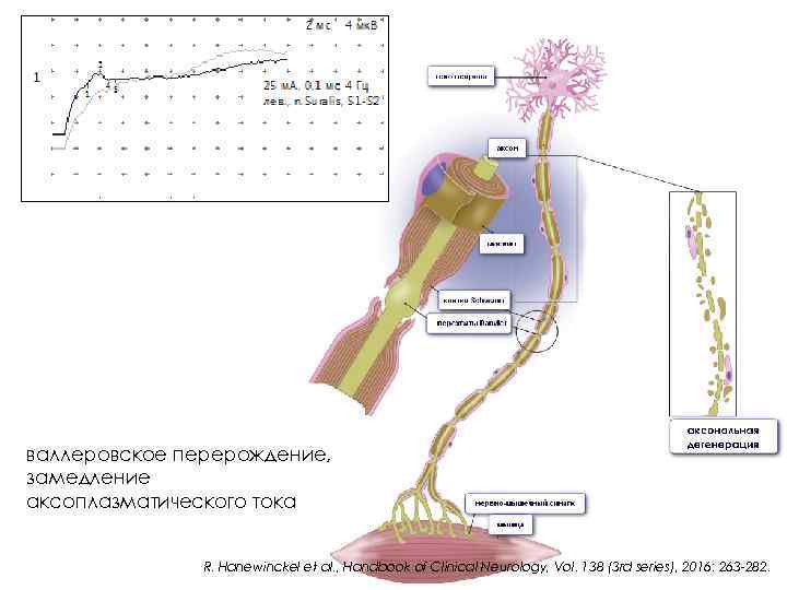 валлеровское перерождение, замедление аксоплазматического тока R. Hanewinckel et al. , Handbook of Clinical Neurology,