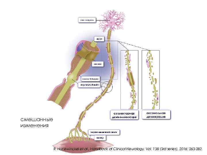 смешанные изменения R. Hanewinckel et al. , Handbook of Clinical Neurology, Vol. 138 (3