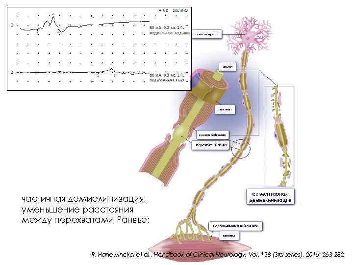 частичная демиелинизация, уменьшение расстояния между перехватами Ранвье; R. Hanewinckel et al. , Handbook of
