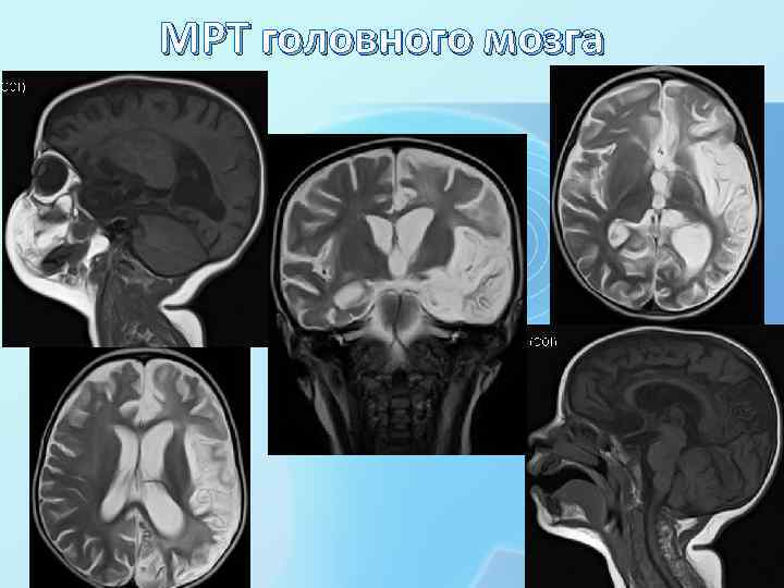 МРТ головного мозга 