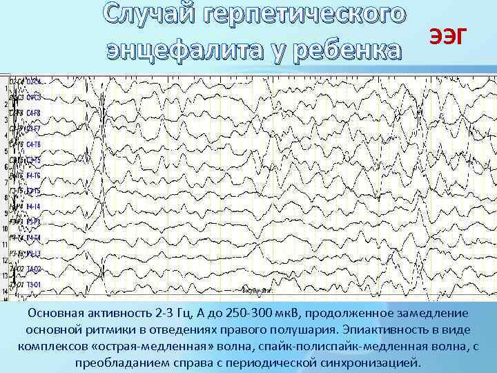 Случай герпетического ЭЭГ энцефалита у ребенка Основная активность 2 -3 Гц, А до 250