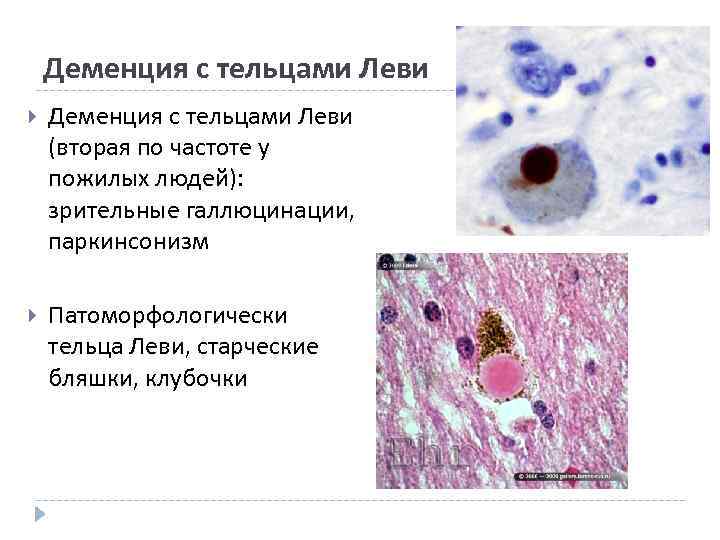 Деменция с тельцами леви что это