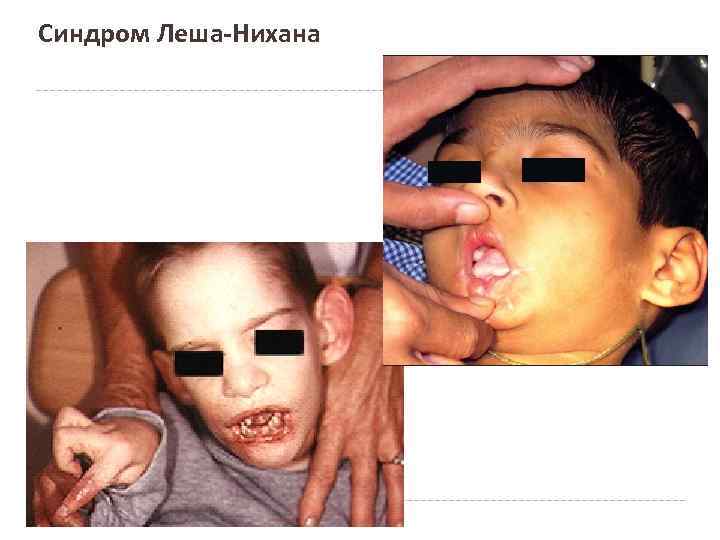 Синдром Леша-Нихана 