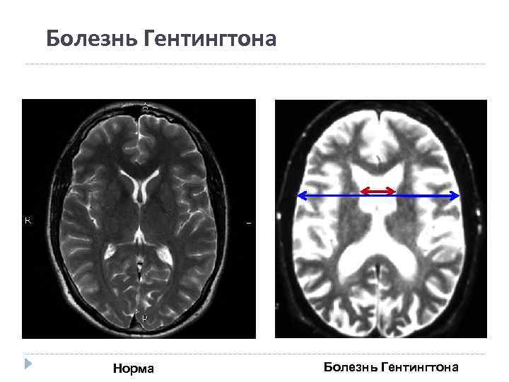 Хореи гентингтона. Синдром Гентингтона. Болезнь Гентингтона мрт. Мозг при болезни Гентингтона.