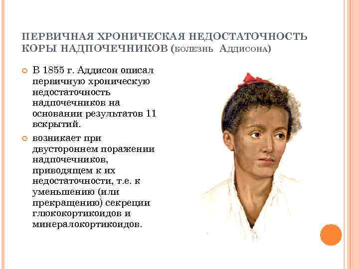 ПЕРВИЧНАЯ ХРОНИЧЕСКАЯ НЕДОСТАТОЧНОСТЬ КОРЫ НАДПОЧЕЧНИКОВ (БОЛЕЗНЬ АДДИСОНА) В 1855 г. Аддисон описал первичную хроническую